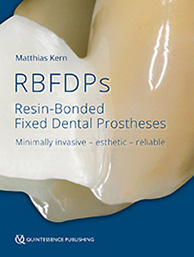RBFDPs:Resin- Bonded Fixed Dental Prostheses(英語版)